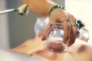 Therapy | The Truth About Chinese Frecupping